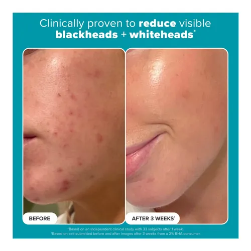 closeup 2 product 655439020169 paulas choice skin perfecting 2 bha l 7618b2710950ce85ec4a947f08022f146f34dd94 1744804301 closeup 2 product 655439020169 paulas choice skin perfecting 2 bha l 7618b2710950ce85ec4a947f08022f146f34dd94 1744804301