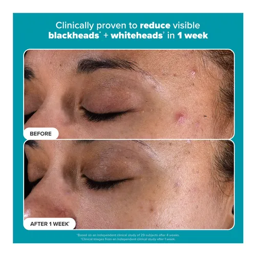 closeup 4 product 655439020169 paulas choice skin perfecting 2 bha l 5b9e75c5b9b0bd3666c7d5bea5be10454bc671df 1744804312 closeup 4 product 655439020169 paulas choice skin perfecting 2 bha l 5b9e75c5b9b0bd3666c7d5bea5be10454bc671df 1744804312